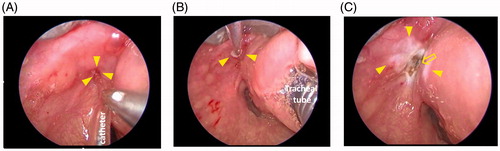 Figure 2. Intraoperative microscopy. (A) Catheter was inserted into the opening of the fistula. (B) Whole length of the fistulous tract was chemocauterized. Small white cotton ball soaked with trichloroacetic acid can be seen. (C) Opening of the fistulous tract was electrically cauterized (arrow), Chemocauterized area can be seen as white lesion (arrow heads).