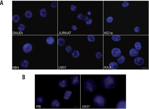 Figure 2. Miniaturized FISH with CEP and LSI probes on tumor cells.(A) Panel of tumor cells with CEP probes for sex chromosomes. Images from representative cells are acquired at 40× objective magnification. Red signal represents chromosome X; green signal represents chromosome Y; scale bar, 10 µm. (B) PB from normal donor (control cells) and U937 cells analyzed with LSI AML1/ETO probe. Images from representative cells are acquired at 100× objective magnification. Red signal represents chromosome 8, while green signal represents chromosome 21; U937 cells showed trisomy for both chromosomes; scale bar, 4 µm.