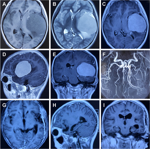 Figure 1 A–F: Preoperative magnetic resonance imaging demonstrating a solid mass of temporal lobe. The tumor viewed with MRI showed isointensity on T1-weighted images (A) and high intensity on T2-weighted images (B) and homogeneous enhancement on T1-weighted gadolinium Enhancement, but no dural tail sign was noted (C–E). CTA showed that the middle cerebral artery adhered closely to the tumor and shifted medially (F). Three-month after the operation, magnetic resonance imaging shows no evidence of disease recurrence (G–I).