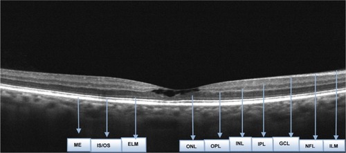 Figure 1 Optical Coherence Tomography of the right eye.