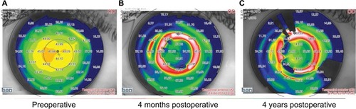 Figure 1 (A) Preoperative and (B and C) postoperative anterior tangential map of the right eye showing the flattening effect of MyoRing.