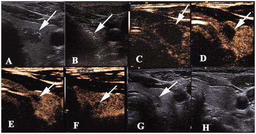 Figure 4. Radiofrequency ablation (RFA) treatment and follow-up of a 46 year-old man with papillary thyroid caner. (A) A hypoechoic nodule with an irregular margin and punctuate echo foci, size 1.1 × 1.0 × 0.7 cm, was detected in the left thyroid lobe (white arrow). (B) The nodule was covered by a hyperechoic area (white arrow) on ultrasonography during the RFA procedure. (C–F) The ablation area decreased gradually to 1.3 × 1.0 × 0.9 cm, 0.8 × 0.8 × 0.5 cm, 0.5 × 0.4 × 0.4 cm, and 0.3 × 0.2 × 0.2 cm 1, 3, 6, and 12 months, respectively, after ablation. There was no enhancement on contrast-enhanced ultrasonography. (G) Ultrasonography 18 months after ablation showed a needle track. (H) The ablation area disappeared on ultrasonography 30 months after ablation.