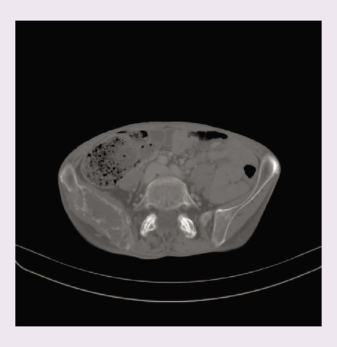 Figure 3. CT scan after embolization demonstrates response of right iliac metastasis with necrosis of the cranial portion of the lesion.