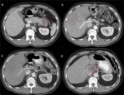 Figure 1. Selected Computed Tomography (CT) Imaging at Clinically Important Timepoints. a) CT at time of diagnosis showing 5 cm distal pancreatic mass. b) CT following four months of adjuvant gemcitabine/capecitabine demonstrating a 1 cm segment V liver metastasis c) CT following three months of FOLFIRINOX showing complete radiographic response of segment V liver metastasis. d) CT two years following metastasectomy demonstrating a 4 cm caudate lobe recurrence