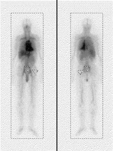 Figure 1. Whole-body images (left: anterior, right: posterior) 24 hours after administration for patient:treatment number 6:1. The total body ROI, the sacrum ROI and the ROI for background correction are shown.