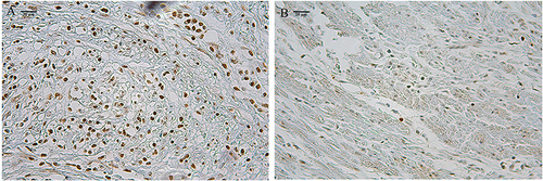 Figure 1 The high- (A) and low-infiltration (B) mast cells by CD203c staining (×400).