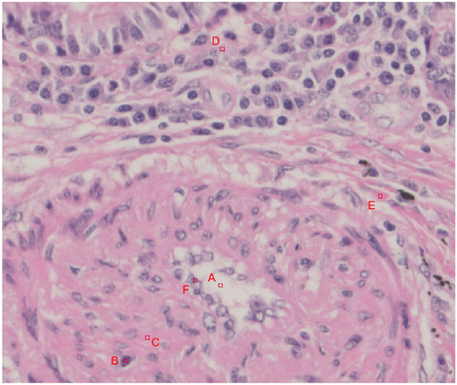Figure 3. Example of an evaluation point set for the feature of a small artery. Evaluation points a through F were selected as candidates for evaluating the reproducibility of the true color values. (A. Angiocentric void, B. smooth muscle cell nucleus, C. smooth muscle cell cytoplasm, D. surrounding cell cytoplasm, E. connective tissue, F. endothelial cell nucleus).