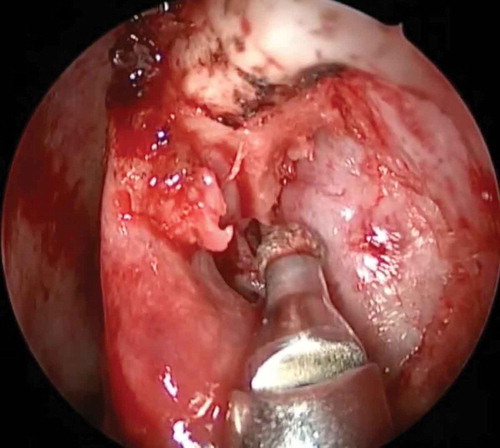 Figure 2. Powered endoscopic DCR: an irrigating-suction diamond burr being used for superior osteotomy and complete exposure of lacrimal sac until the fundus of the sac.