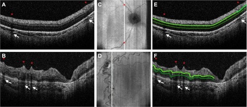 Figure 4 Evaluation of infant retinal vasculature with SDOCT.