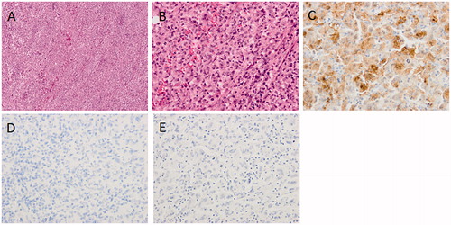Figure 3. Microscopic finding of resected tumor. (A) Hematoxylin and Eosin (HE) stained finding in low power field. (B) HE stained finding in high power field. (C) S-100 immunostained finding. (D) Langerin immunostained finding. (E) CD21 immunostained finding.