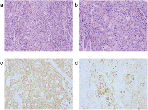 Figure 3. Hematoxylin and eosin (HE) staining and immunohistochemical (IHC) staining of the surgical specimen. (a) HE staining (magnification, ×100); (b) HE staining (magnification, ×200); (c) IHC analysis for hepatocytes (magnification, ×100); (d) IHC analysis for AFP (magnification, ×100).