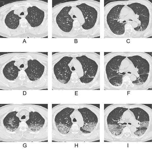 Figure 6 An 80-year-old male patient infected with the Omicron variant. (A–C) Initial computed tomography (CT) images revealed a few patchy ground-glass opacities (GGOs) in both lungs. (D–F) Four days later, this patient’s RT-PCR results turned negative, but his respiratory tract symptoms were aggravated with a progressive increase in the levels of interleukin-6. Follow-up CT images showed imaging progress with increased GGOs in both lungs. (G–I) Eight days later, follow-up CT images showed that GGOs were further increased in both lungs, accompanied by a crazy-paving pattern and small pleural effusion.