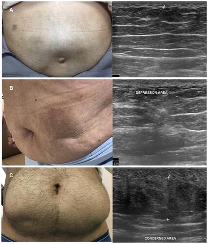 Figure 2 (A) A typical insulin-induced lipohypertrophy in T2DM patient with ultrasound characteristics of thickening heterogeneous echogenicity of subcutaneous fat. (B) Insulin-induced lipoatrophy in a patient with long-standing T2DM with ultrasonographic findings of lipoatrophy revealed a focal area of decreased thickness and increased heterogeneous echogenicity of subcutaneous fat texture. (C) A T1DM patient with suspected insulin-derived localized amyloidosis based on palpable subcutaneous mass at subumbilical region and homogeneous hypoechoic fat interspersed from ultrasound.