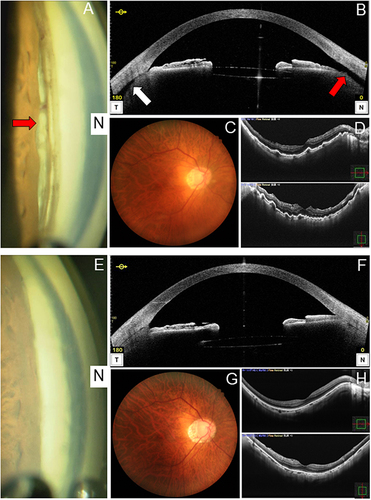 Figure 1 Angle and fundus findings before and after minimally invasive direct internal cyclopexy in case 1. (A) Preoperative gonioscopy in the nasal angle. The red arrow indicates a post-goniotomy cyclodialysis cleft of about 90°. (B) Preoperative anterior segment optical coherence tomography (AS-OCT) in the horizontal direction confirming the presence of a cleft (red arrow) along with a 360-degree ciliochoroidal detachment (white arrow). Anterior chamber-superior choroidal space traffic is clear. (C) Preoperative fundus camera image showing mild dilation and vascular tortuosity. (D) Preoperative OCT showing chorioretinal folds, which indicates hypotony maculopathy. (E) Postoperative gonioscopy finding in the nasal angle. The cyclodialysis cleft is repaired. Scattered peripheral anterior synechiae formations are visible after the cyclopexy. (F) Postoperative AS-OCT in the horizontal direction confirming repair of the cleft and disappearance of the ciliochoroidal detachment. (G) Postoperative fundus camera image showing mild dilation and vascular tortuosity are improved. (H) Postoperative OCT finding showing improved chorioretinal folds and the return of the retinal shape to normal, which indicates the resolution of hypotony maculopathy.