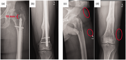 Figure 2. Radiographs of the navigated nail removal. (a, b) Healed femoral pseudarthrosis after re-nailing; deep placement of the nail in the medullar cavity (18 mm) made the implant removal demanding. (c, d) Postoperative X-ray control showing complete nail removal via less invasive incisions (red circles).