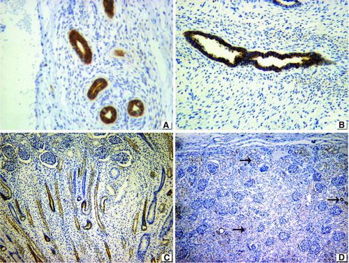 FIGURE 4  BCL2 expression. (A) Positive cytoplasmic staining in dysplastic tubular epithelium of obstructive MCDK. (B) Similar positivity in non-obstructive MCDK. (C) Positive in nephrogenic zone of fetal kidney. (D) Minimal expression in the tubules of normal control (arrows). 76 × 57 mm.