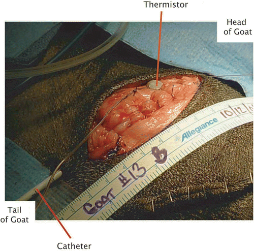Figure 2. Intra-operative appearance of the inserted balloon and the subcutaneous thermistor.
