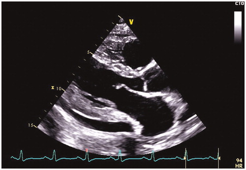 Figure 2. An echocardiographic image taken in the parasternal long axis view demonstrates moderate pericardial effusion in the posterior pericardium.