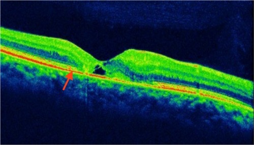 Figure 10 Macular telangiectasia showing juxtafoveal disruption of ISel band and ELM (red arrow).