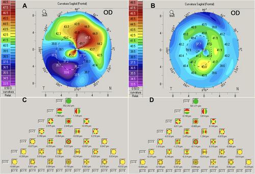 Figure 7 Preoperative and postoperative topographic, and aberrometric changes after TE-TG-PTK at 12 months follow-up. Sagittal maps (A, B) show substantial regularization of the corneal surface: Kmax decreased from 44.0 D preoperatively (A) to 41.5 D postoperative (B) without a major decrease in Kmean (41.3 D (A) to 40.8 D (B)). Zernike analysis (C, D) also shows considerable changes in total coma with figures decreasing from 2.84 um preoperatively (C) to 0.070 um (sum of the mean root square) at final follow-up (D). This patient had previous diagnosis of diffuse corneal leucomas secondary to adenoviral keratoconjunctivitis, and gained 6 lines of Snellen CDVA (from LogMAR 1.92 to −0.1) at final follow-up.