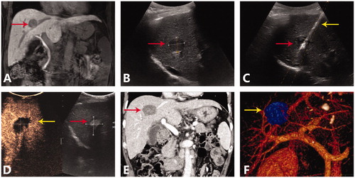 Figure 2. A representative case of ultrasound-guided percutaneous MWA for HCC abutting large vessel. (A) Preoperative MRI scan showed single nodule (red arrow) adjacent to the middle hepatic vein. (B) Preoperative ultrasound showed a hyperechoic nodule (red arrow) about 2.2 cm and 2.4 cm in size. (C) Insertion of antenna (yellow arrow) to the nodule (red arrow) under the US guidance. (D) Postoperative CEUS examination showed complete ablation of tumor. (E) On the venous phase of postoperative CT scan, no enhancement was seen in the ablation zone, the middle hepatic vein was unobstructed without thrombosis. (F) Postoperative three dimensional reconstruction showed that the ablation zone (yellow arrow) had exceeded the middle hepatic vein, and there was no related vein injury.