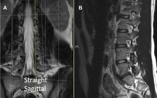 Figure 6 Standard parasagittal cuts were taken in 2- to 4-mm slices. (A) demonstrates coronal image with standard cut line (yellow line). (B) demonstrates parasagittal image respective to slice in (A).