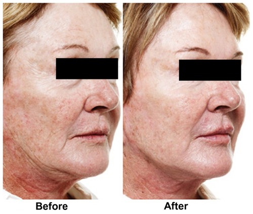 Figure 10 A 69-year-old patient showing a full facial decrease of 14 years in self-assessed age, with the upper face decreasing by 16 years and the lower face decreasing by 19 years following intervention with botulinum toxin and hyaluronic acid fillers in these regions.