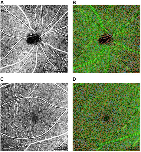 Figure 1 (A) Peripapillary scan in the superficial layer. (B) The resulting images of peripapillary scan in superficial layer after AngioTool analysis. (C) Macular scan in the superficial layer. (D) The resulting images of macular scan in superficial layer after AngioTool analysis.