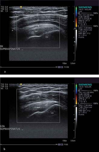 Figure 3. A and b. Ultrasound of both shoulders in a 33 year old male patient with unilateral subacromial pain syndrome.