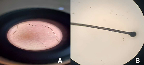 Figure 3 Trichoscopy findings. (A) Preserved follicular Ostia but empty (B) The anagen hair root is pigmented and covered by sheath.