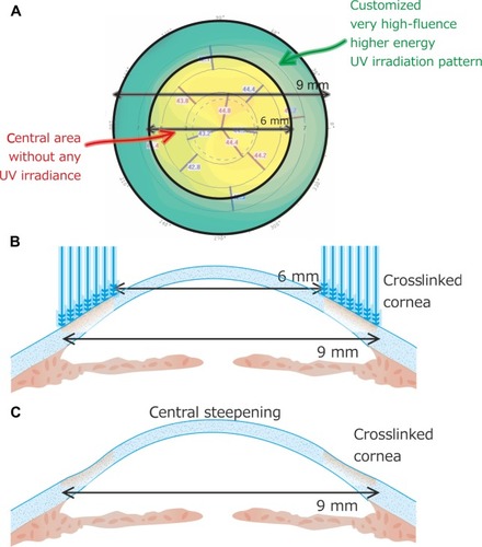 Figure 2 Customized profile employed in the hyperopic treatment.