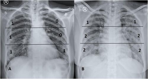 Figure 2 Two case illustrations of applying Modified Chest X-ray Scoring System on AP projection. (A). The total calculated score of the 6 chest divisions is 4, classified as mild severity score. (B) The total calculated score of the 6 chest divisions is 9, classified as severe severity score.