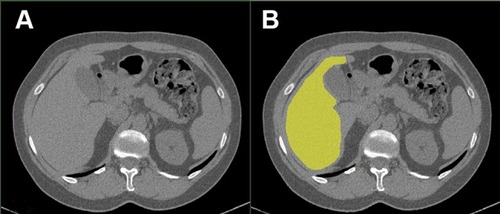 Figure 1 Example of a computed tomography slice before (Panel A) and after segmentation (Panel B).