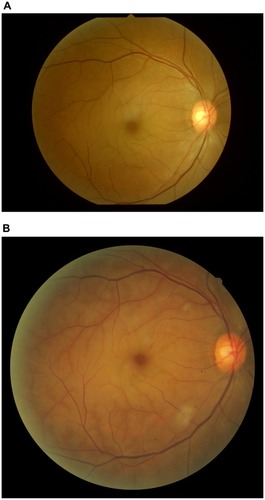 Figure 1 Color photograph of the right fundus showing a cherry-red spot in the macula (A). Retinal whitening became marked with soft exudates (B).
