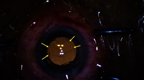 Figure 9 Image of optic capture involving the three-piece intraocular lens. The edge of the continuous curvilinear capsulorhexis is indicated by the yellow arrows.