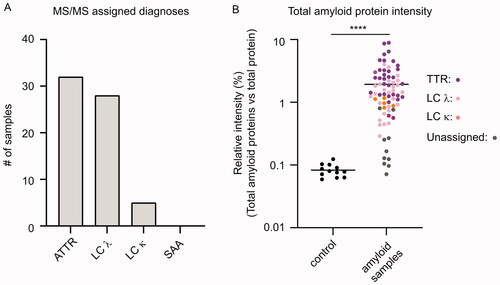 Figure 3. Distribution of the proteomic-based amyloid-typing. (A) TTR was assigned as the pathogenic amyloid-precursor protein in 32 cases. LC λ and LC κ were assigned in 28 and 5 cases, respectively. SAA was not assigned as the amyloid-protein in any of the cases. (B) Relative intensity (%) of the sum of four amyloid proteins (TTR, LC λ, LC κ and SAA) in relation to the total protein intensity in individual control and patient samples, coloured according to the proteomic results. Mean relative intensities for controls and amyloid samples were 0.083% and 1.93%, respectively. Unpaired student T-test. p < 0.001 (****).