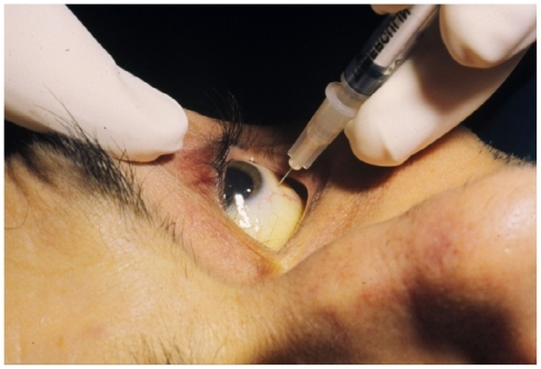 Figure 3 Intravitreal injection of ganciclovir through the pars plana.