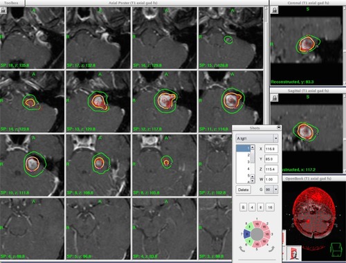 Figure 1 An illustration of multi-isocenter, multi-beam irradiation of a left-side VS lesion on a Gamma Knife Icon system, where utilization of multiple isocenters and multiple directional shaped beams of variable beam diameters create the desired dose distribution.Abbreviation: VS, vestibular schwannoma.