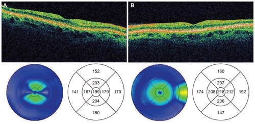 Figure 4 Time domain OCT images of the macula of the right a) and left b) eyes 28 months postingestion showing atrophy of the neuroretina.