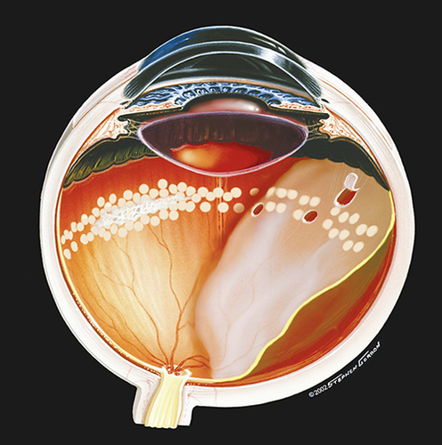 Figure 2 Illustration of failed encircling laser prophylaxis as performed via a mirrored contact lens before the advent of IDO laser delivery. Image ©(2002)Stephen F. Gordon.