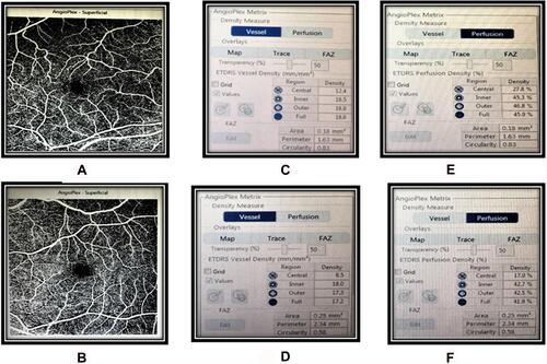 Figure 1 Vessel density, perfusion density, and FAZ metric values compared between a healthy control (A, C, E) and a patient with non-proliferative diabetic retinopathy (B, D, F).
