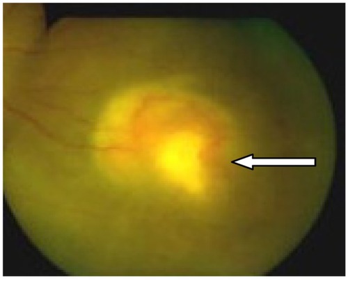 Figure 3 Subretinal abscess (arrow) in an immunocompromised 27-year-old woman with tuberculosis on highly active antiretroviral therapy.