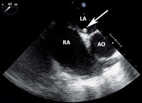 Figure 3. Transesophageal echocardiographic short-axis view showing the right atrium (RA), left atrium (LA), aorta (AO) and thrombus through the foramen ovale (arrow).