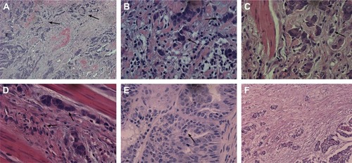 Figure 1 Microscopic observations for gastric adenocarcinoma (HE stain).