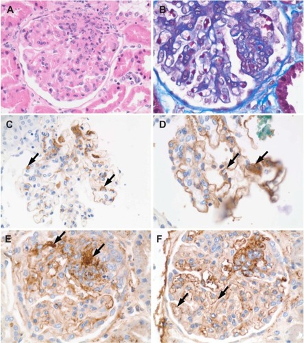 Figure 8 When tissue for immunofluorescence microscopy is not available, special histological stains and conventional immunohistochemical staining visualized with diaminobenzidine (DAB) can reveal glomerular deposits in Class III to Class VI. (A) Hematoxylin and eosin showing some crowding of nuclei in a segmental mesangial proliferative lesion; (B) Masson’s trichrome stain showing segmental mesangial proliferation and thickened capillary loops; (C) deposits of IgM (arrows); (D) deposits of IgG (arrows); (E) mesangial deposits of C3c (arrows); (F) deposits of C3c in capillary loops.