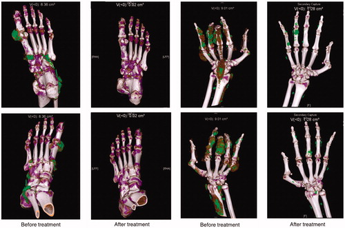 Figure 1. Distribution of MSU crystal before and after treatment. The paired foot and ankle DECT images belong to Patient 28. MSU load in the left foot reduced 99.9% from 8.36 cm3 to 0.02 cm3. The paired hand and wrist DECT images belong to patient 17. MSU load in the right hand reduced 86% from 9.01 cm3 to 1.28 cm3. Flexion contracture in middle finger improved. Power grip improved 2.8 times. (Remark: Green colour represents MSU crystal).