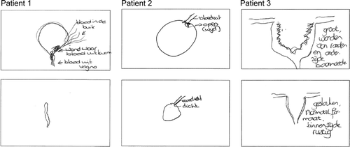 Figure 2. Clarifying text: Top: uterus during procedure. Bottom: uterus during interview. Drawing 1 Top: Abdominal blood. Wound at exit uterus. Bottom: Blood from vagina. Drawing 2 Top: Wide open vessel. Bottom: Vessel closed. Drawing 3 Top: Big wounds lateral and lower side of uterus. Bottom: Closed, normal size, calm inner side.