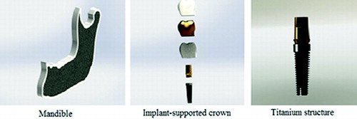 Figure 1. Mandible, implant-supported crown and titanium structure (abutment + implant body) model.