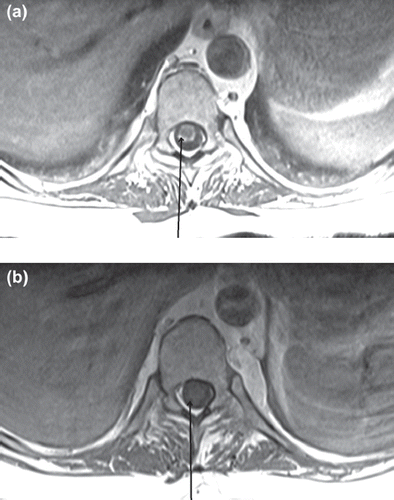 Figure 3. (a) Pre-treatment axial T1 weighted post-contrast MR image of the spinal cord – areas of leptomeningeal involvement are indicated by the arrow and are visible as an area of enhancement that encircles the spinal cord. In (b) improvement is noted and is indicated by the arrow.