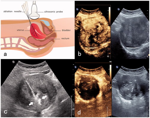 Figure 1. MMWA for a patient with adenomyosis who had anemia. (a) Diagram of trans-abdominal ultrasound-guided ablation of the myometrial lesion. The ‘mobile-layered ablation’ technique was adopted to move the ablation needle from deep to superficial positions in a fan-shaped ablation zone; (b) preoperative contrast-enhanced ultrasonography showed hyper-enhancing lesions in the arterial phase; (c) ultrasound-guided ablation of myometrial lesions with a thermal field of hyperechoic signals around the ablation needle (white arrow); (d) postoperative contrast-enhanced ultrasonography reveals no perfusion in the myometrial ablation area.
